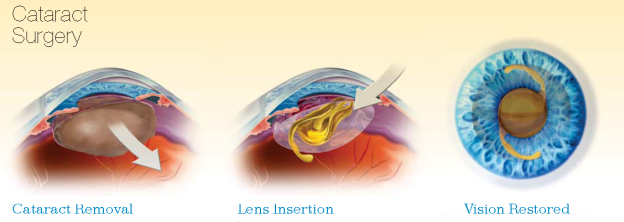 Cataract Surgery