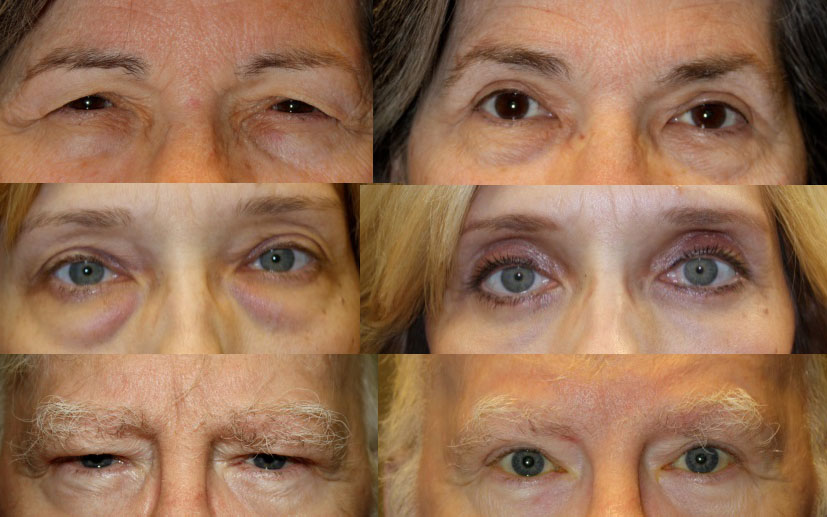 Eyelid Surgery